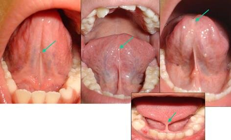 Close-up images of different types of tongue ties, showing varying degrees of restriction and attachment points under the tongue